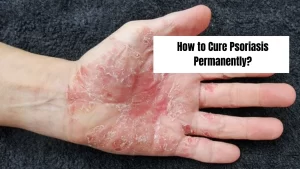 How-to-Cure-Psoriasis-Permanently