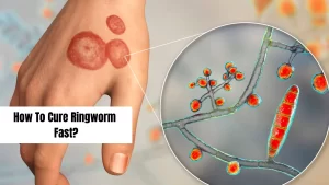 How-to-cure-Ringworm-fast